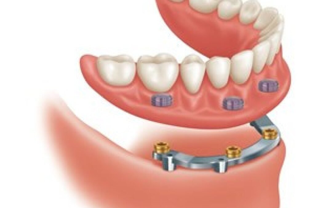 PROTOCOLO DE BRANEMARK