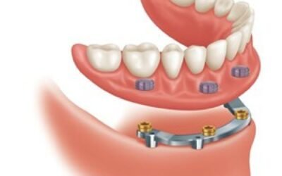 PROTOCOLO DE BRANEMARK